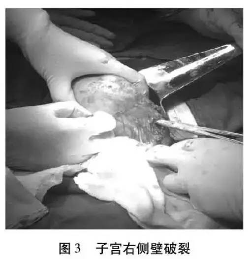 输卵管切除并发症,输卵管妊娠手术风险