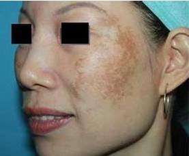 激光祛斑1-15天变化图,皮秒激光祛斑有啥副作用