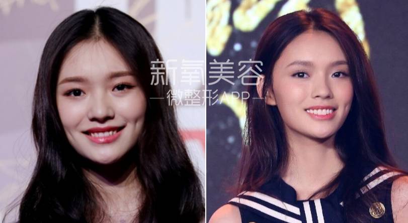 林允整牙却像整容？她是真的又整了啊！