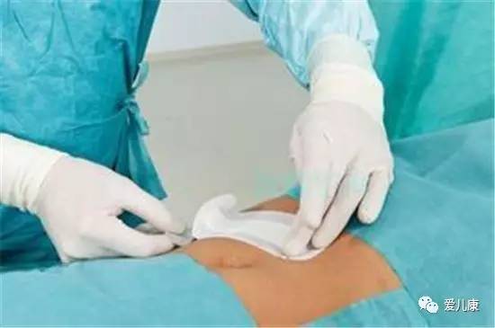 剖腹产伤疤怎么恢复好,剖腹产伤疤修复方法