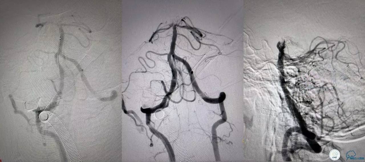 一例急性基底动脉尖综合征患者的支架取栓治疗