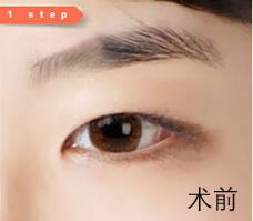 做了双眼皮后眼皮按压痛,为什么割了双眼皮牙会痛