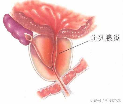 啪太多竟增癌变风险？学会5招保护男子汉“生命腺”