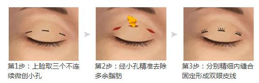 割双眼皮选医生真实经验分享,割双眼皮不能不知道的7个潜规则
