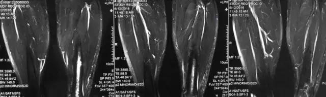 骨折内固定伤口处流脓是为什么,骨折固定支架外部流脓怎么处理