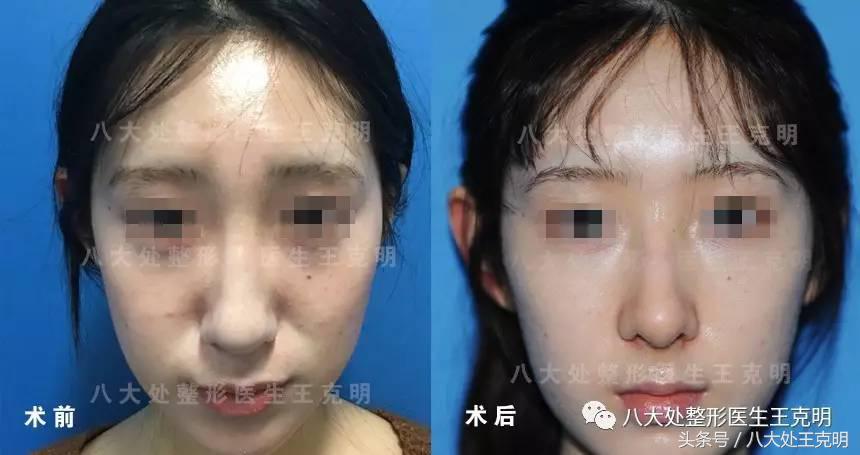 肋软骨隆鼻如何选择合适的形态,肋软骨隆鼻和耳软骨隆鼻哪个安全