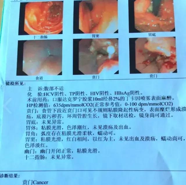 胃底贲门中分化腺癌怎么来根治,胃底贲门低中分化腺癌能治愈吗