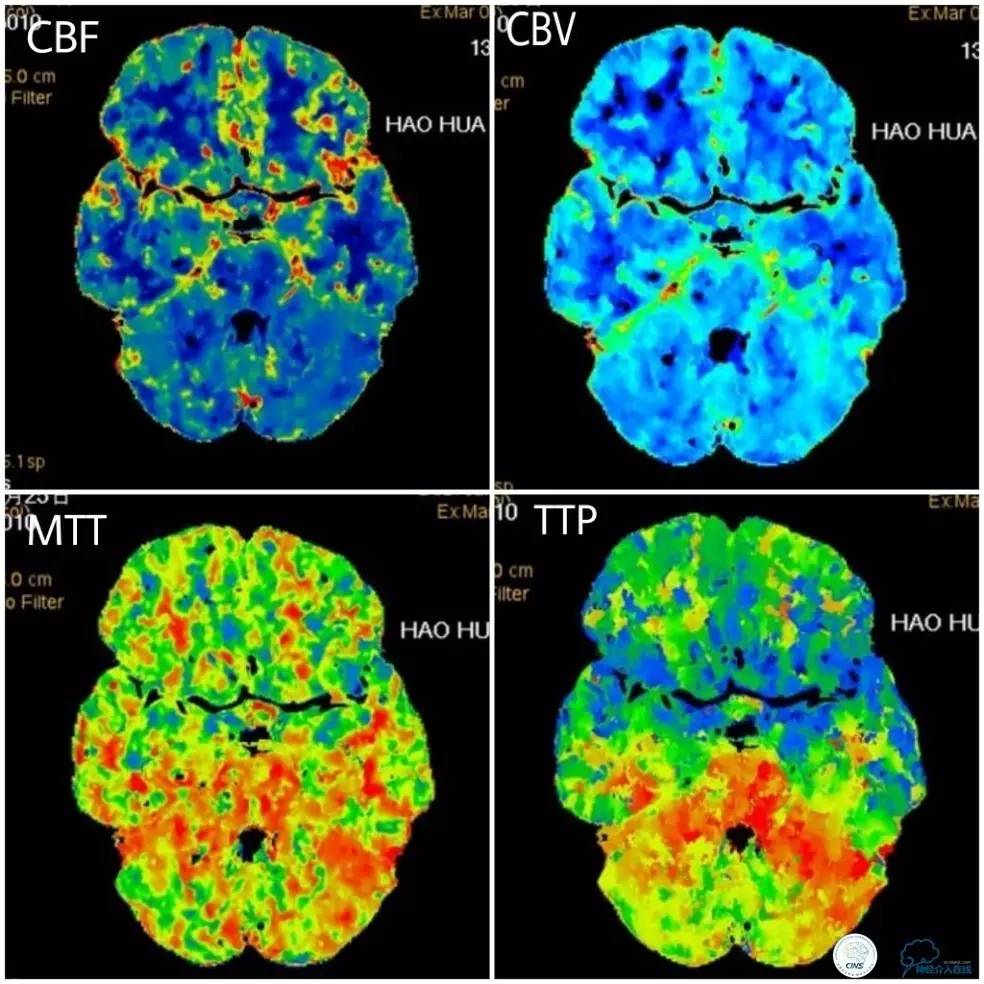 天坛周记｜右椎动脉V1段及V4-基底动脉串联病变支架治疗一例
