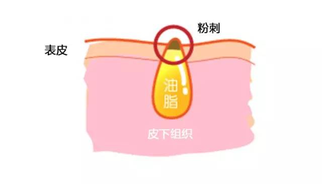 挤痘痘出来的白色东西很臭,挤痘痘出来的白色东西是什么