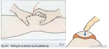 膝盖积水什么颜色，病就是什么样的