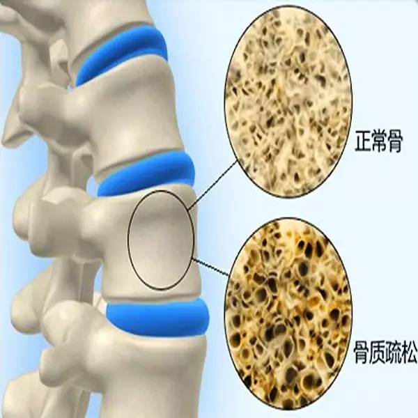 45岁腰酸背痛是什么原因引起的,腰酸背痛是什么原因引起的男人