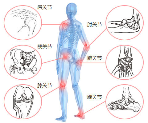 风湿全解｜夏季风湿关节炎危害大，如何有效治疗和预防？
