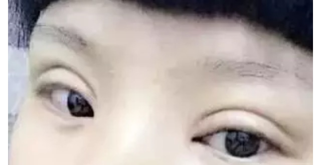 和阿姨的双眼皮做的太宽失败了