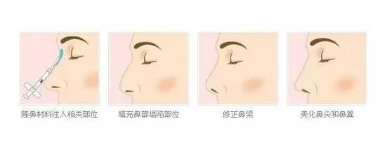 鼻子垫的太往上了,鼻子垫得不高是不是不容易歪