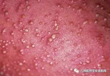痱子疹子怎么治,大人痱子和热疹