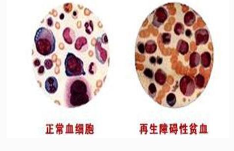 儿童再障发病率,再障儿童有什么病理现象