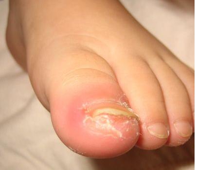 折磨我们的甲沟炎到底怎么回事？