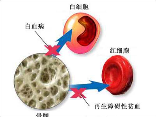 儿童再障发病率,再障儿童有什么病理现象