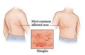 皮疹的五种症状,各种皮疹的症状