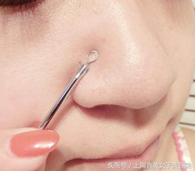 鼻子黑头怎么去除最有效知乎,小孩鼻子上黑头怎么去除最有效