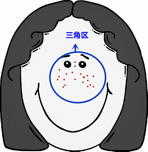 脸部痘痘看身体状况,超全面面部痘痘分析图文