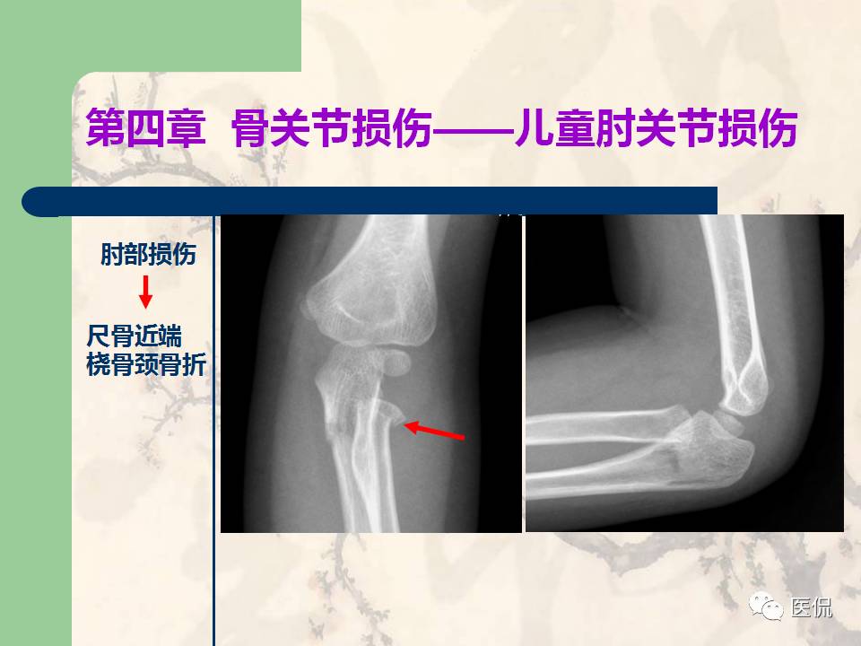 骨关节创伤x线诊断图谱,骨关节损伤x线图