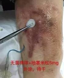 敷料致接触性皮炎，护士这样换药处理，效果极佳！