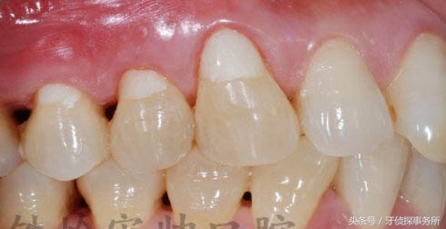 纳米补牙和树脂补牙区别,自己用补牙材料补牙