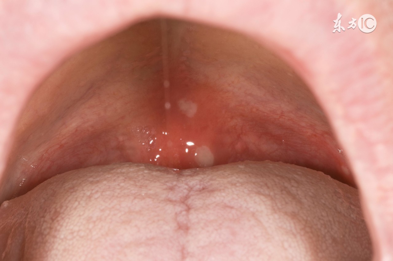 新生儿长鹅口疮怎么办,新生儿鹅口疮不治疗会自愈吗