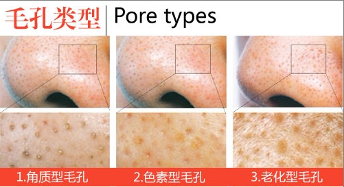 点阵激光可以解决皮肤老化吗,激光点阵和射频