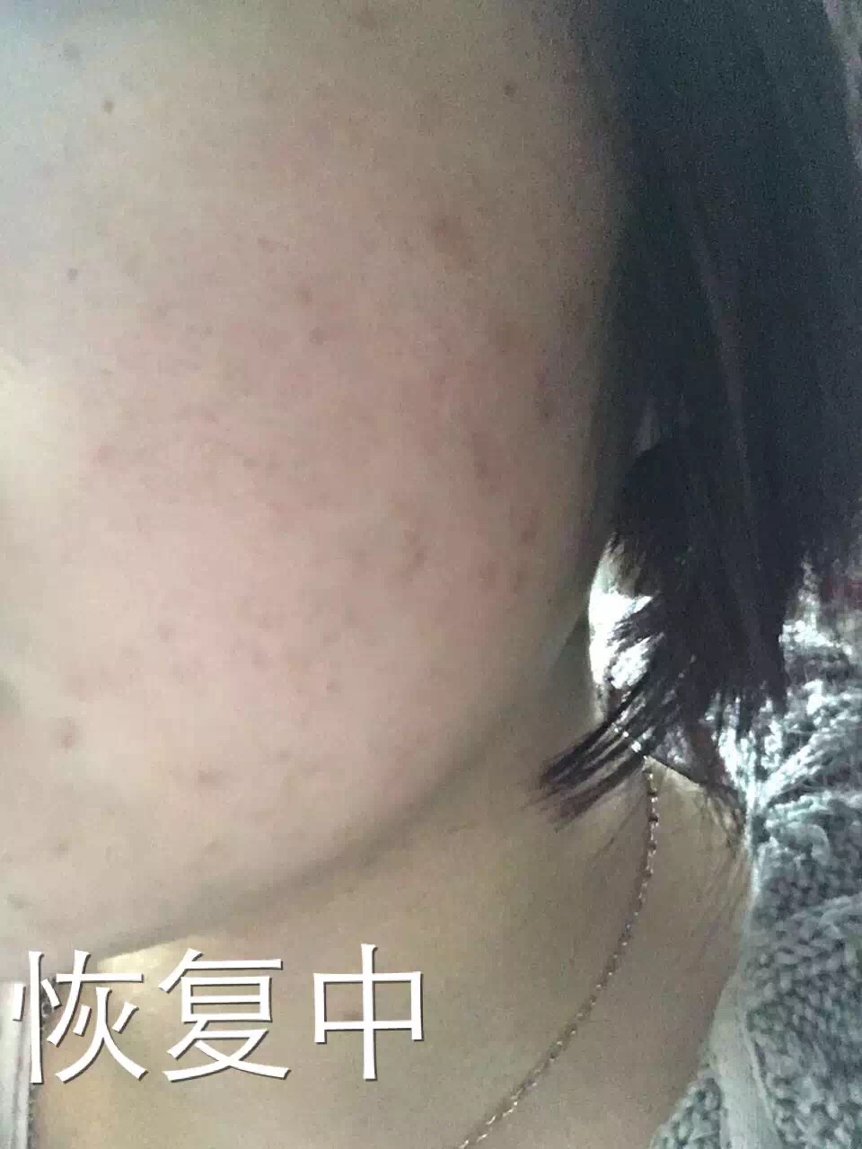 慎入！春季多发激素脸！你还要不要脸？