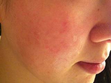 季节性过敏和季节性湿疹,季节性过敏和皮肤过敏的区别