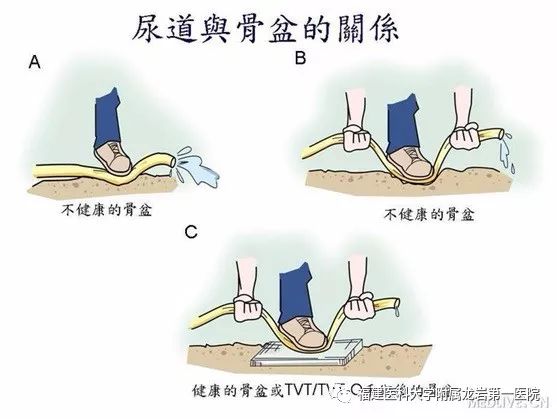 笑尿了是病吗,笑尿了是肾的问题吗