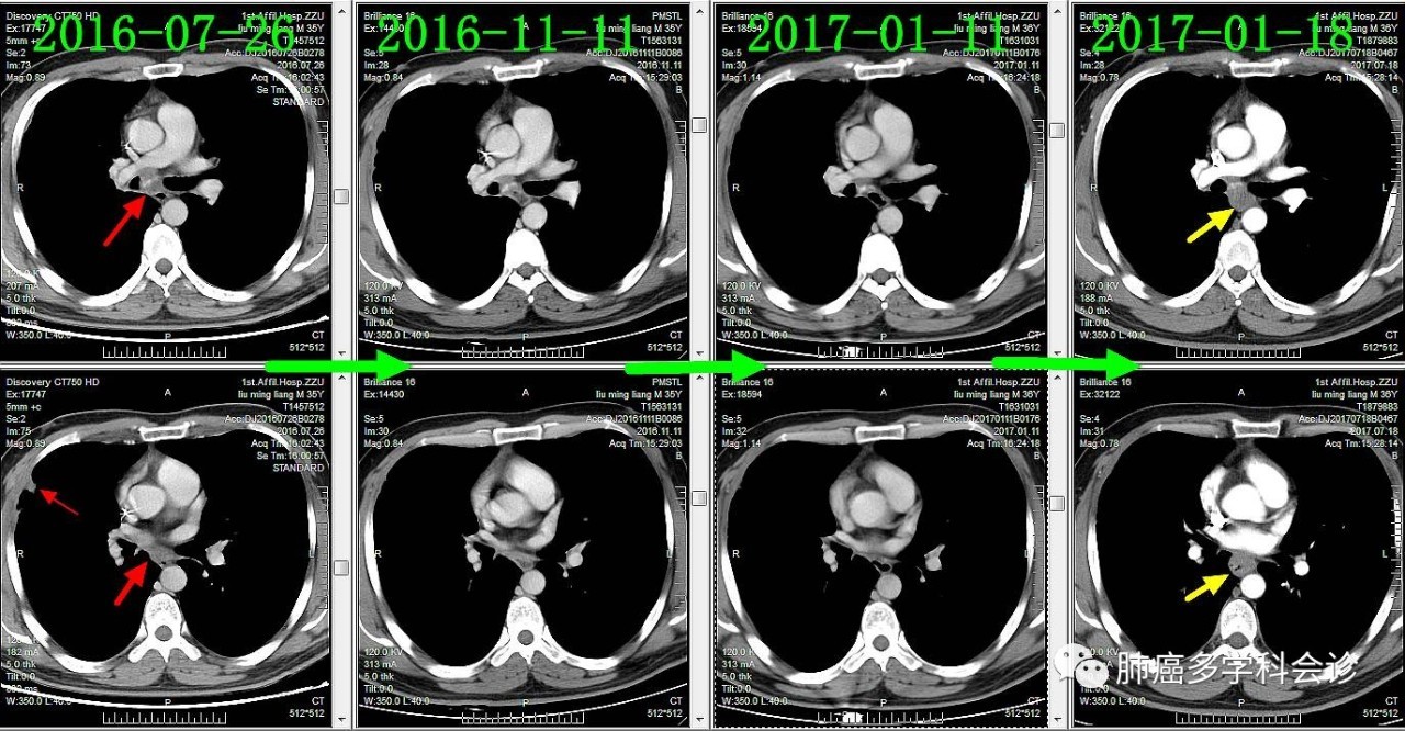 食管癌转移两侧淋巴癌严重吗,食管癌转移和扩散区别