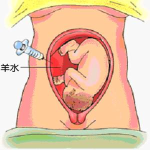 唐氏筛查高风险神经缺陷,中期唐氏筛查提示高风险