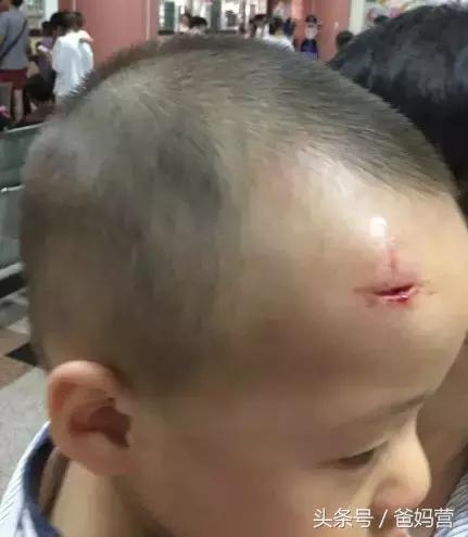 2岁宝宝摔跤手指破皮出血,小孩子摔跤出血去医院缝针