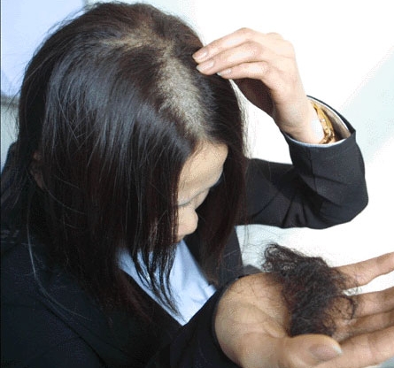 正常掉发范围明显感觉到头发稀疏,头发稀疏掉得厉害是怎么回事