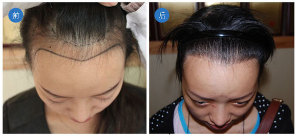 发问｜植发是选择植发机构还是三甲医院？