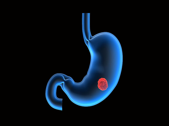 胃癌患者早期十大症状,胃癌详细解说