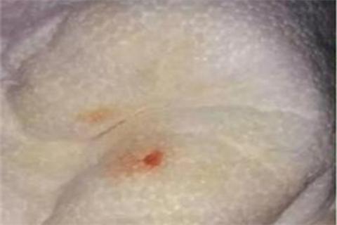 1岁来月经又来了怎么回事,孩子一个月反复来例假