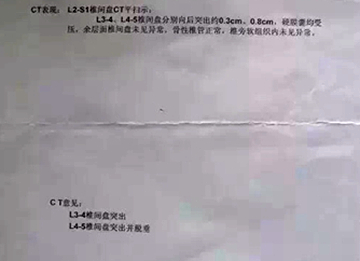 腰椎间盘膨出突出和脱出的区别,腰椎间盘突出膨出脱出哪个更严重