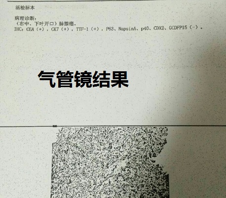 脑袋长疖子的最佳治疗方法,头皮上长了一个火疖子