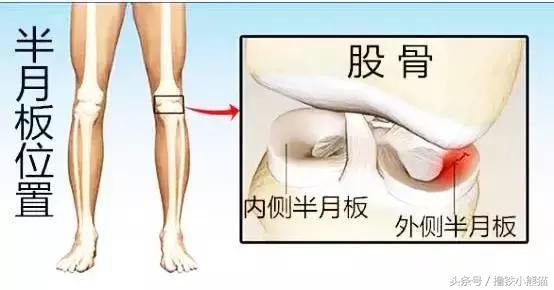 全方位解析，美国专业医生告诉你：膝关节损伤如何识别及自我治疗