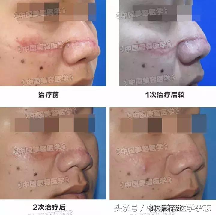 点阵激光治疗下颌瘢痕疙瘩有效么,二氧化碳激光治疗瘢痕增生原理