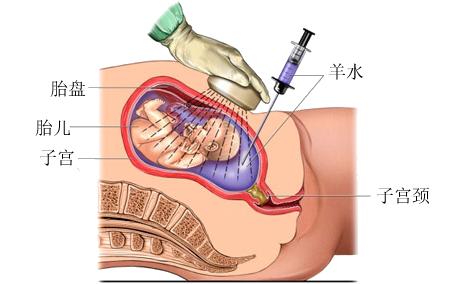 唐筛低风险就一定没问题吗,唐筛异常是高危还是低危