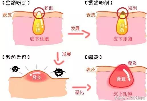 干货亲测最强去闭口攻略,亲身测评如何安全有效的去闭口