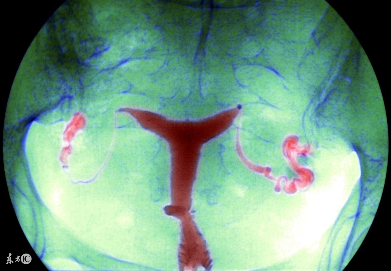 盆腔炎导致的不孕能根治吗,盆腔炎导致不孕新闻