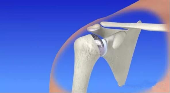 肱骨近端骨折内固定康复动作,肱骨近端骨折关节置换