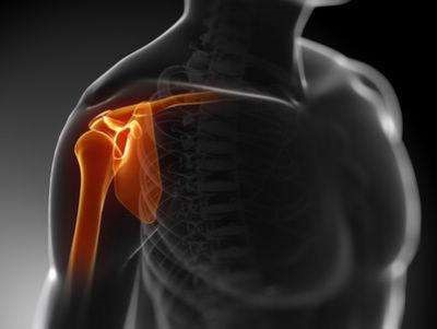 肱骨近端骨折内固定康复动作,肱骨近端骨折关节置换