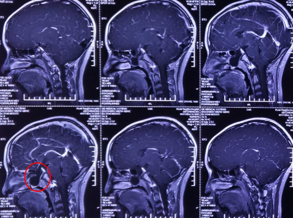 脑膜膨出手术是用什么修补的,蝶鞍区脑膜膨出手术怎么做